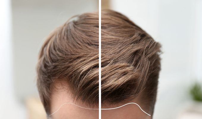 „STAY SAFE“ - RUNDUM-PFLEGE NACH IHRER HAARTRANSPLANTATION